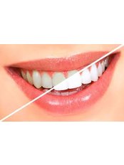 Teeth Whitening - dr.richa's dental serinity miraroad mumbai