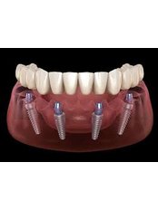 All-on-4 Dental Implants - dr.richa's dental serinity miraroad mumbai