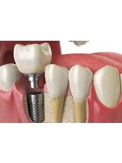 Dental Implants - dr.richa's dental serinity miraroad mumbai