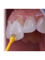 Veneers - dr.richa's dental serinity miraroad mumbai