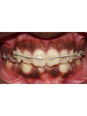 CERAMIC BRACES - Embrace Orthodontics