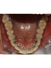LINGUAL BRACES - Embrace Orthodontics