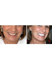 Zoom! Teeth Whitening - Family Dental