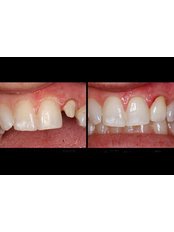 Dental Crowns - Family Dental