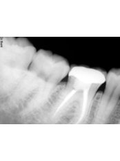 Digital Dental X-Ray - iDENT Clinic