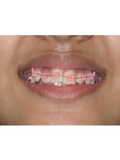 Ceramic Braces - Idyll Dental