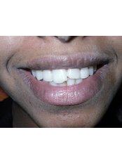Dental Bonding - Idyll Dental