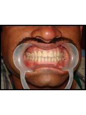 PFM Bridge - Idyll Dental