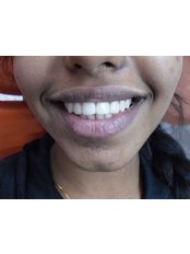 Dental Bonding - Idyll Dental