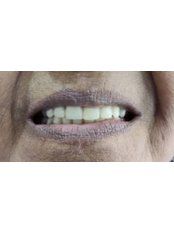 Dentures - Kare Dental Clinic
