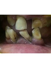 Dental Implants - Kare Dental Clinic