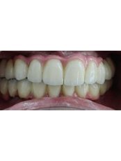 Dental Implants - Kare Dental Clinic