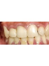 Teeth Whitening - Kare Dental Clinic