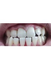 Teeth Whitening - Kare Dental Clinic