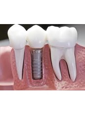 Single Implant - MAX Dental Clinic