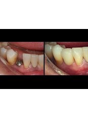 Restoration of Implants - MAX Dental Clinic