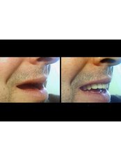full moth rehabilitation - MAX Dental Clinic