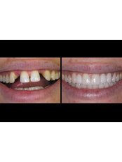 Implant and veneers - MAX Dental Clinic