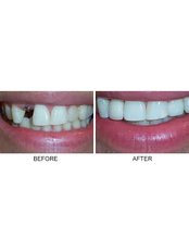 Dental Implants - MAX Dental Clinic