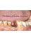 Microscope Enhanced Dentistry at Dr. Bartakke's - Implant - Placement of healing abutment 