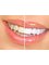 Moon Smile Dental Clinic - whitening before after 