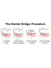 Temporary Bridge - Smile Speak Dental Clinic