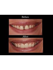 Porcelain Bridge - Smile Speak Dental Clinic