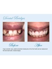 Dental Bridges - Smile Speak Dental Clinic