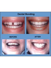 Dental Bonding - Smile Speak Dental Clinic