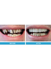 Composite Veneers - Smile Speak Dental Clinic