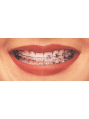 Clear Braces - Smile Speak Dental Clinic