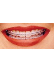 Ceramic Braces - Smile Speak Dental Clinic