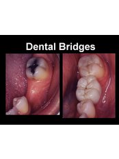 Dental Bridges - Smile Speak Dental Clinic