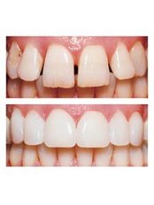 Porcelain Veneers - Smile Speak Dental Clinic