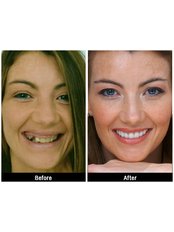 Implant Dentist Consultation - Smile Speak Dental Clinic