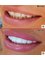 Sunfill Dental Clinic - Full Upper and Lower Arch Veneers 