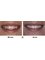 Sunfill Dental Clinic - Smile Correction using Veneers 