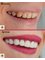 Sunfill Dental Clinic - Full Upper Arch Veneers in 1 hour 