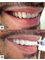 Sunfill Dental Clinic - Full Upper and Lower Arch Veneers 