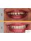 The Dental Bond - Our 40year old female patient was unhappy with the gaps between her teeth. She wanted a fast ans durable method to correct same. 4 ceramic veeners were made for her upper front teeth. The treatment was completed in two visits over a period of 5 days. 