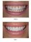 V Smile Dental Clinic - veneers 