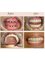 V Smile Dental Clinic - dental implants 