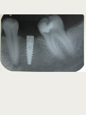 32 smiles. your gum care and beyond...!!! - dental Implant