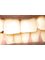 32 smiles. your gum care and beyond...!!! - after placement of Crown(prosthesis) 