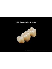 Porcelain Bridge - Dental Cosmetic & Implant Centre