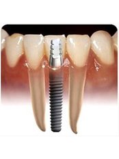Keyhole Dental Implants - Dental Cosmetic & Implant Centre