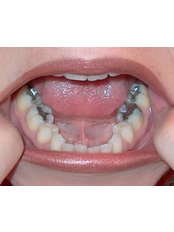 Fillings - Dental Cosmetic & Implant Centre