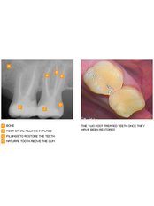 Root Filling - Dental Cosmetic & Implant Centre