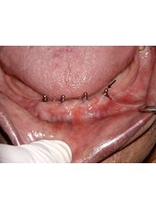 Mini Implants - Dental Cosmetic & Implant Centre