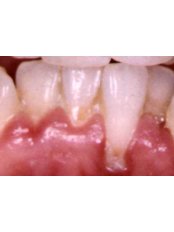 Gingivitis Treatment - Dental Cosmetic & Implant Centre